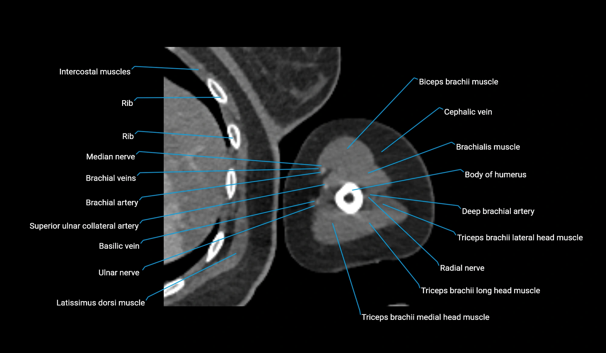 CT upper arm axial  cross sectional anatomy labelled radiology image -00276.webp